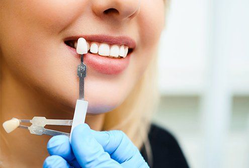 Smile compared with tooth shade model