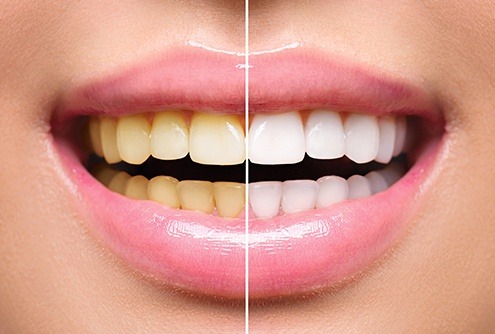 Smile before and after teeth whitening