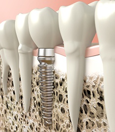 3D illustration of dental implant  