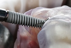 Dental implant being inserted into model of jawbone