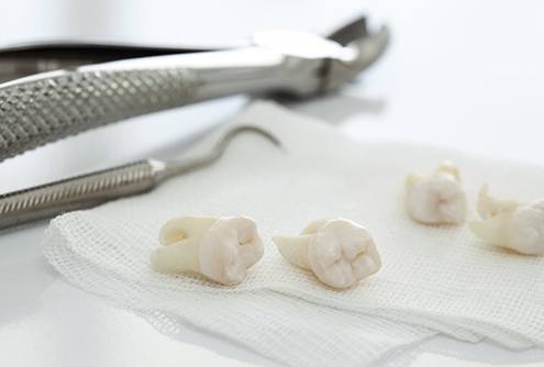 several extracted teeth lying on top of gauze pads
