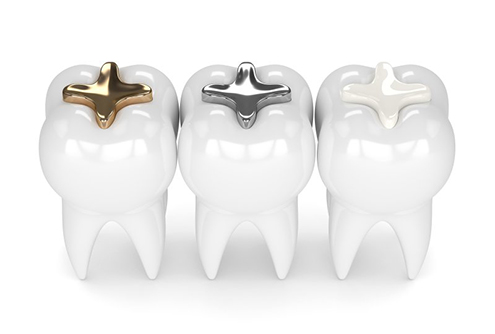 tooth with gold filling, tooth with silver filling, tooth with composite filling 