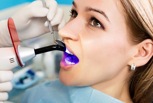 young woman getting tooth-colored filling hardened with UV light 