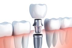 Closeup of dental implant in McMinnville