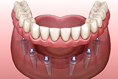 Diagram of implant dentures in McMinnville being placed
