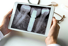Closeup of dental implants in McMinnville 