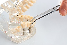 McMinnville implant dentist placing model dental implants