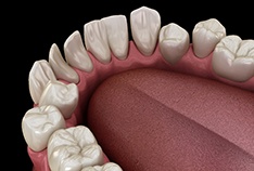 Illustration of spaced out teeth