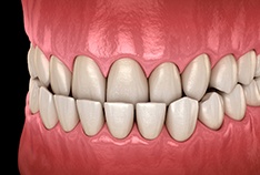 Illustration of underbite