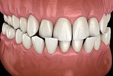 Illustration of crossbite