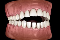 Illustration of open bite
