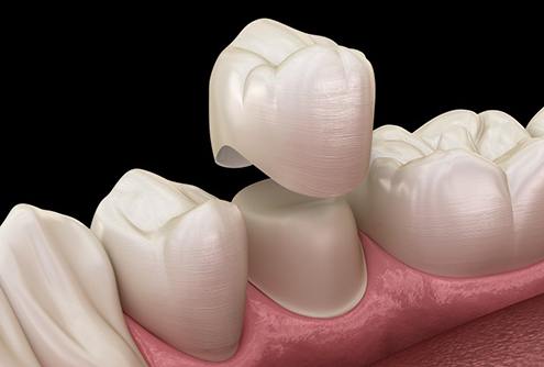 dental crown being placed over bottom tooth 