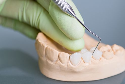 Model smile with fixed bridge restoration