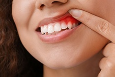 a woman showing signs of gum disease