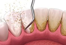 a 3 D illustration of scaling and root planing