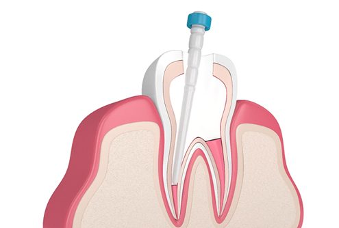 Diagram of the root canal process in McMinnville