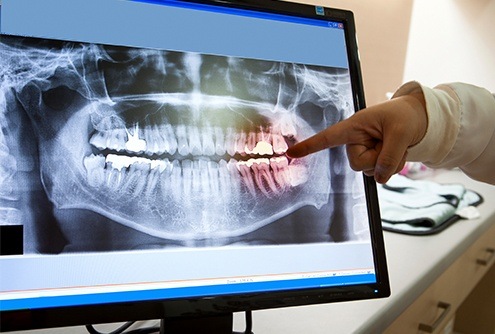 Digital dental x-rays on computer screen