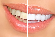 Cheap whitening results vs. professional whitening results