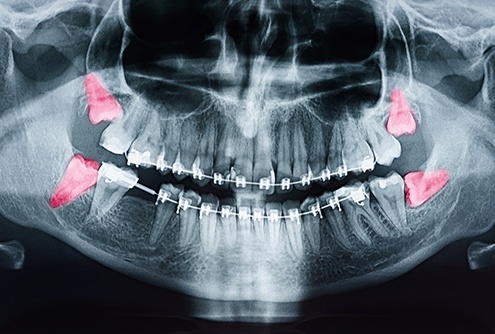 Wisdom teeth highlighted in red on X-ray