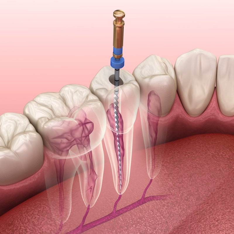 3-D diagram of a root canal