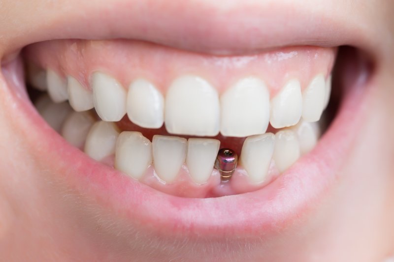 a dental implant in someone’s mouth