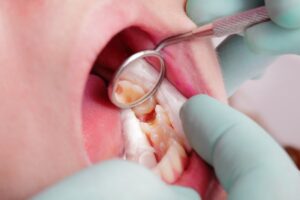 Close-up on dental cavity.