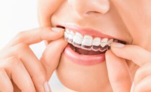 Close-up of Invisalign fitting onto teeth.