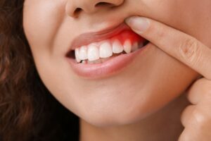 Woman showing off red gums. 